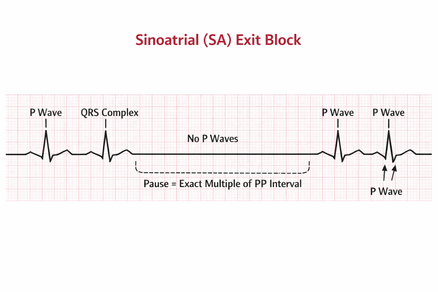 Sinoatrial Block - ICUNOTES