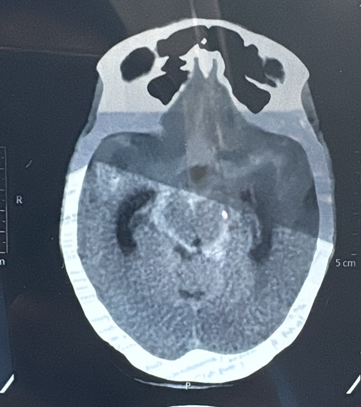 sub arachnoid hemmorhage in NCCT head