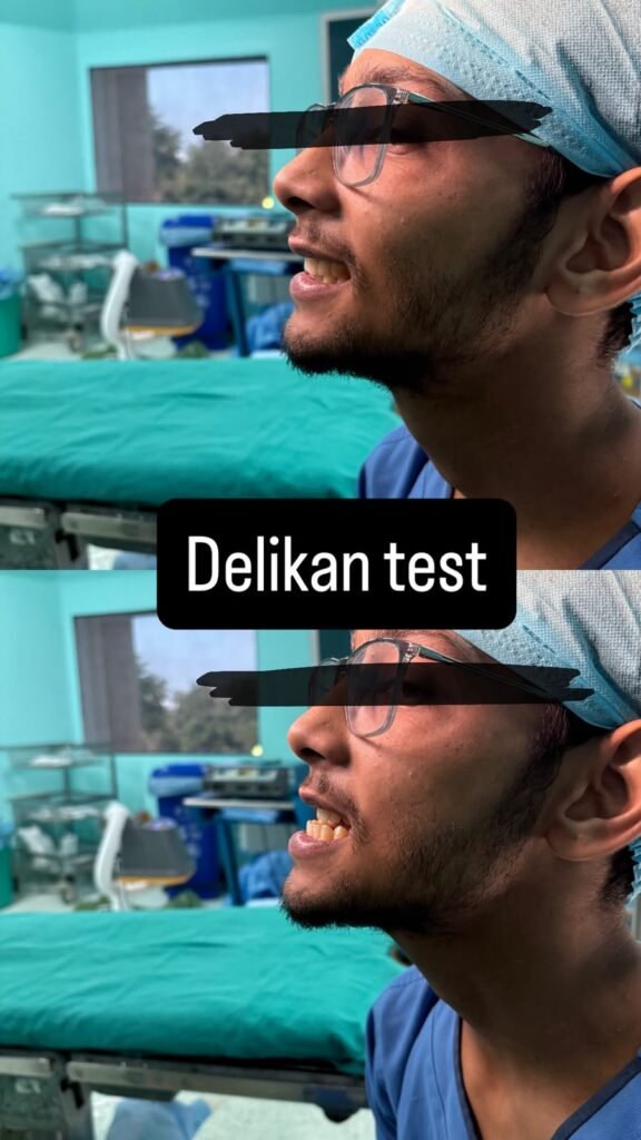 Delikan test