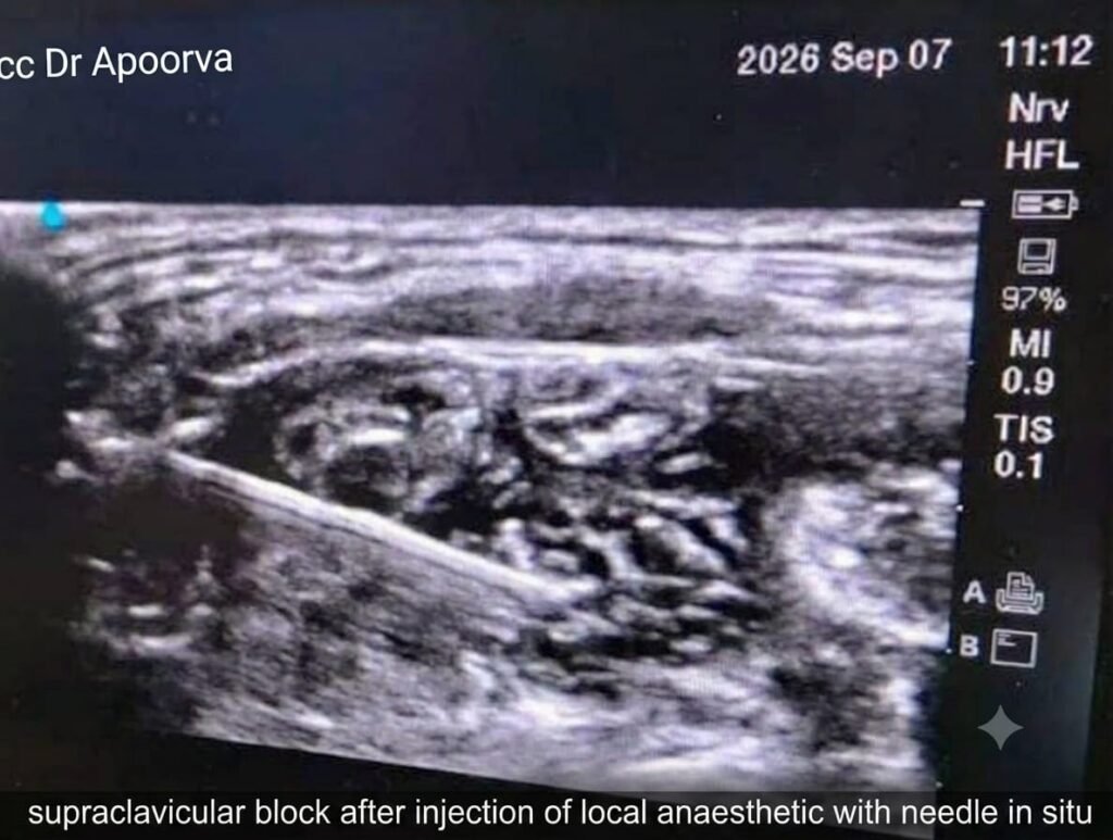 Supraclavicular block USG guided