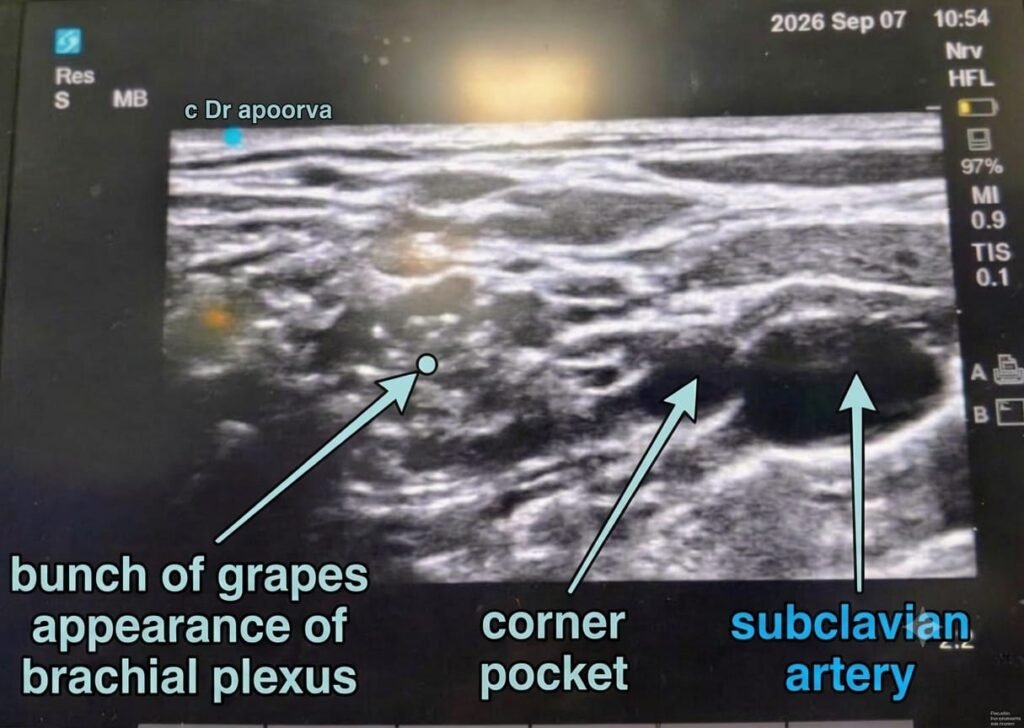 Supraclavicular block USG guided