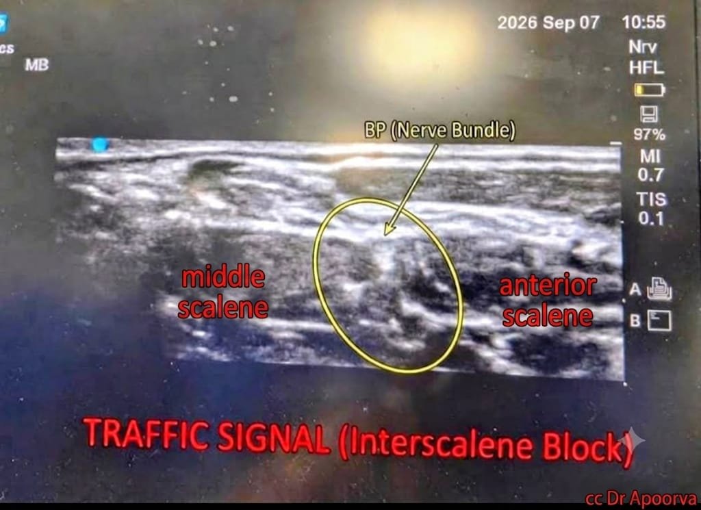 interscalene block