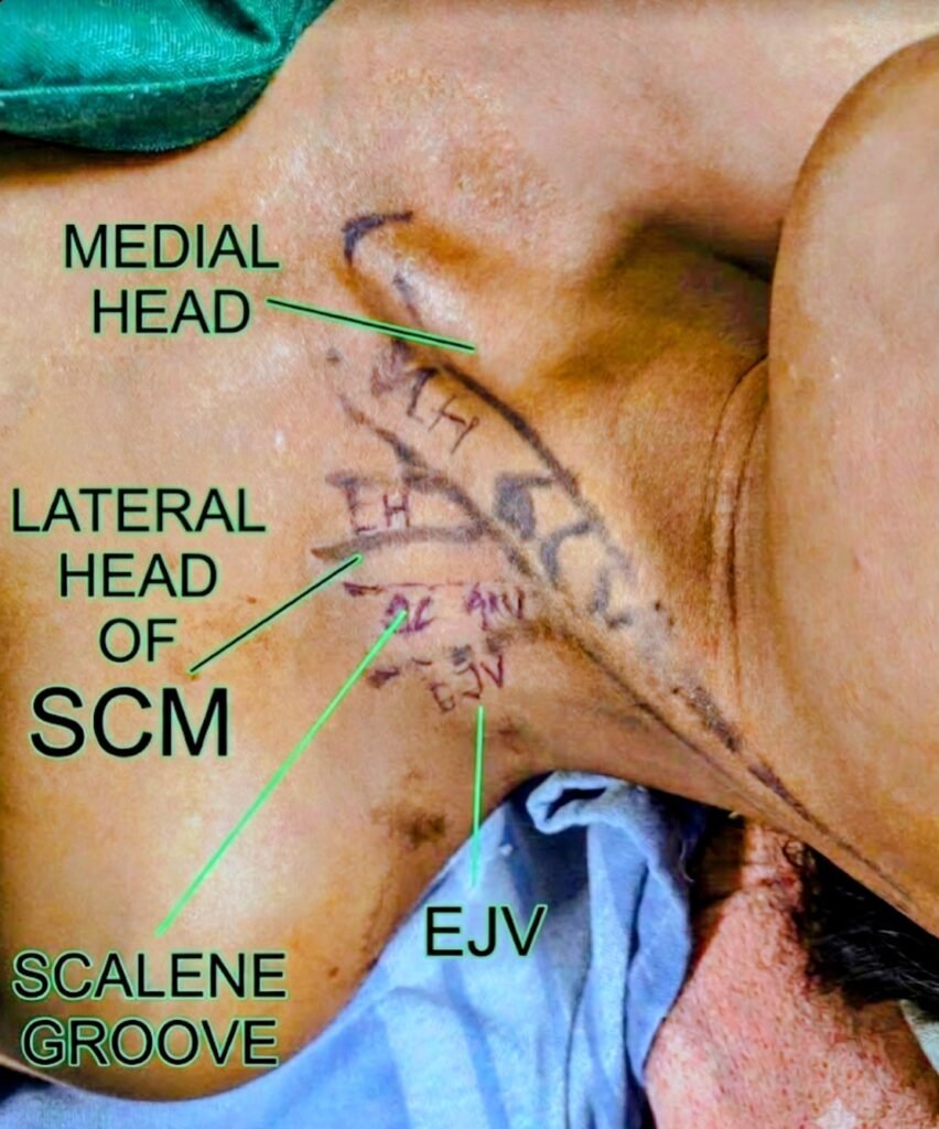 interscalene block