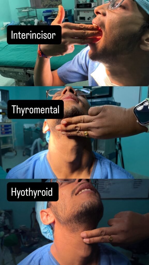thyromental distance